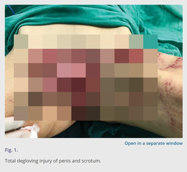 【閲覧注意】手やペニスの皮が全剥けしても修復可!! 医学誌掲載の驚異的「デグロービング損傷」再建手術事例の画像1