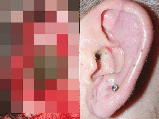 【閲覧注意】医療用ヒルによる耳の再接着が完璧すぎる！ 医学誌掲載の目覚ましい成功事例の画像1