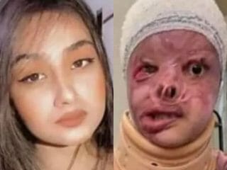 アシッドアタックで「顔の80%が溶けた19歳の超美女」が悲しすぎる！ 被害者なのに加害者家族から脅迫され…＝イラク