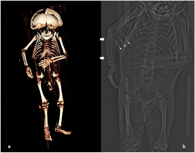 赤ん坊のミイラから驚愕の死因が判明! 肥満なのに栄養欠乏、愛されすぎた子の末路…の画像4