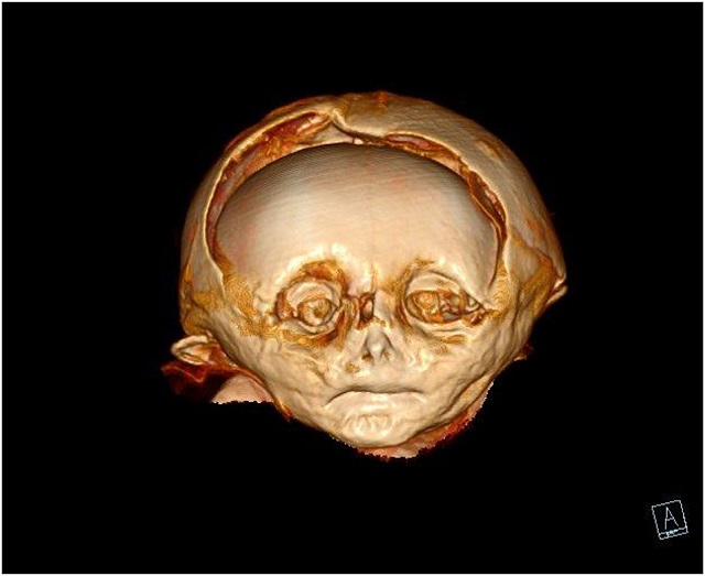 赤ん坊のミイラから驚愕の死因が判明! 肥満なのに栄養欠乏、愛されすぎた子の末路…の画像3