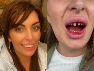 トルコの格安歯科医にとんでもない歯にされてしまった女性！ 医療観光の危険性を警告