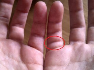 小指に「余分な関節」が存在する人がいる？ 発生確率1%以下の超レアケース