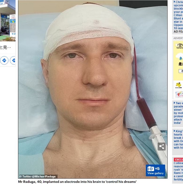 素人が自分自身に脳外科手術を敢行! ロシアのリアルブラックジャックに医師が警鐘を鳴らすの画像1