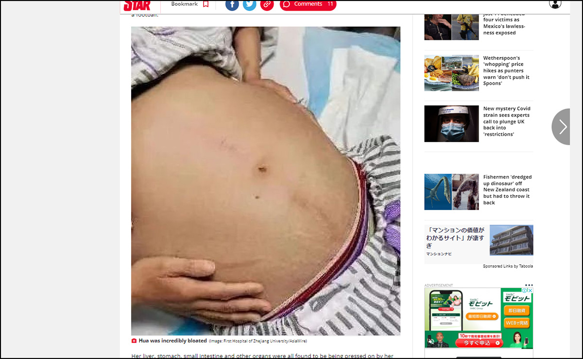 まるで20kgのニシキヘビ… 重度の便秘に悩む女性から摘出された「巨大すぎる便」の画像2
